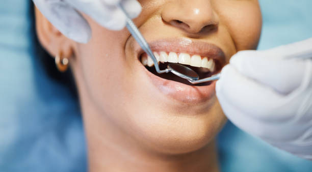 Best Emergency Wisdom Tooth Extraction in Connell, WA
